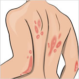 Psoriasis Treatment