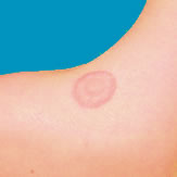 Ringworm Treatment