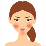 Rosacea Treatment